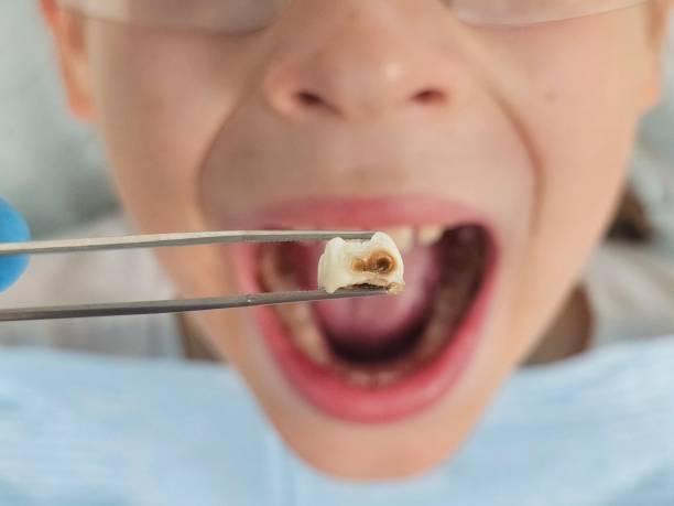 Best Emergency Wisdom Teeth Removal in Ball Pond, CT